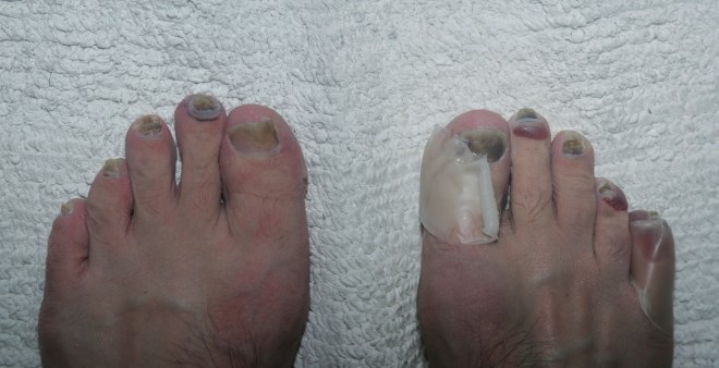 Meine Füße nach den 100 Kilometern