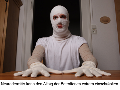 neurodermitis1 neurodermitis1